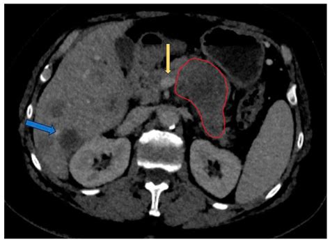 Pancreatic Adenocarcinoma: Imaging Modalities and the Role of ...