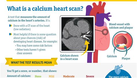 Coronary Artery Calcium Scoring (CAC) | Doctors Without Waiting Rooms