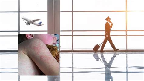Measles Alert Issued After Exposure At Two Major US Airports: All You ...