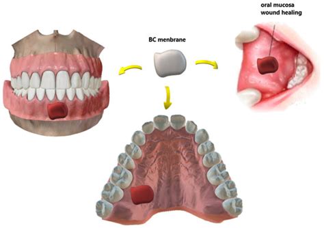 Bacterial Nanocellulose in Dentistry: Perspectives and Challenges