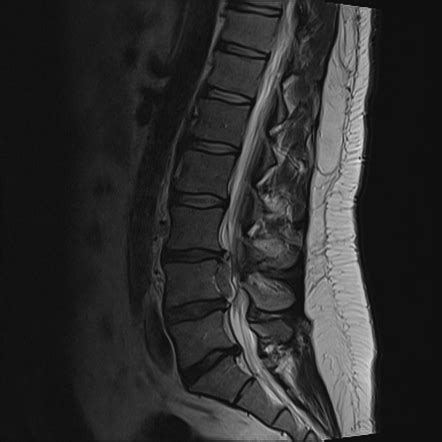 Image result for Foraminal Disc Extrusion