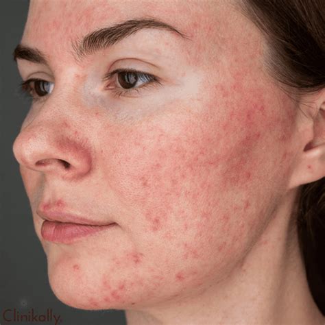 Understanding Rosacea: Signs, Symptoms, and Risk Factors | Clinikallly