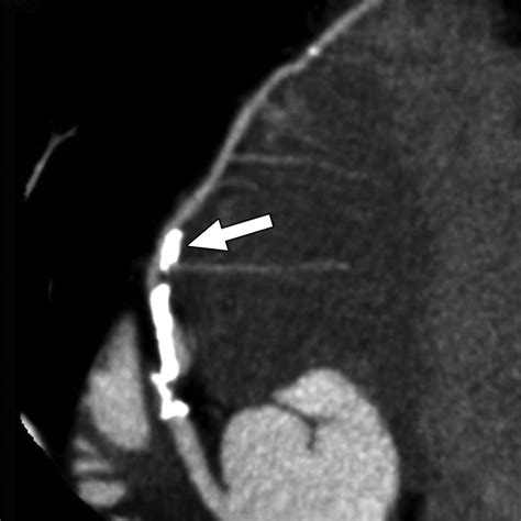 Accuracy of MDCT in Assessing the Degree of Stenosis Caused by Calcified Coronary Artery Plaques ...