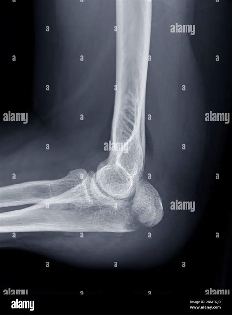 X-ray of Elbow join showing fracture of ulna bone Stock Photo - Alamy