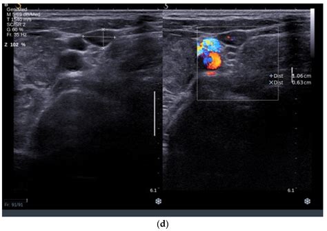 Medullary Thyroid Carcinoma in Patients with Graves’ Disease—A Case ...