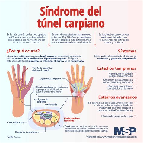 Síndrome del Tunel Carpiano - Infografía