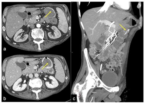 The Role of CT-Angiography in the Acute Gastrointestinal Bleeding: A Pictorial Essay of Active ...