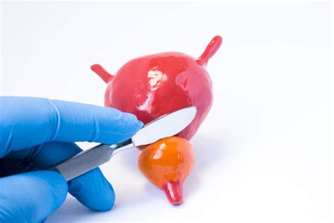 Actual Prostate Surgery 的图像结果