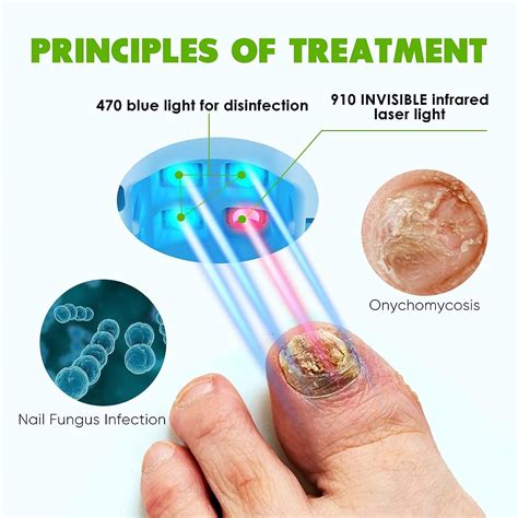 Nail Fungus Laser Treatment Device - Blue Light Therapy for Onychomycosis - Easy At-Home ...