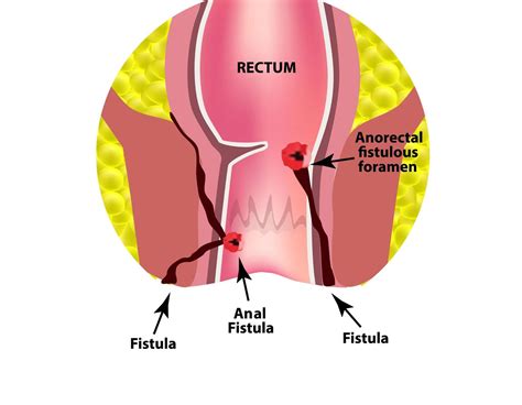 Ischiorectal Abscess Fistula Anal Fistula Treatment Newcastle NSW