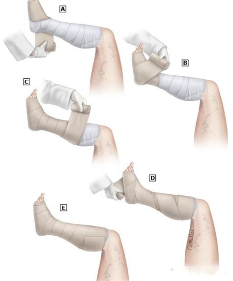 Image result for Applying a Compression Bandage