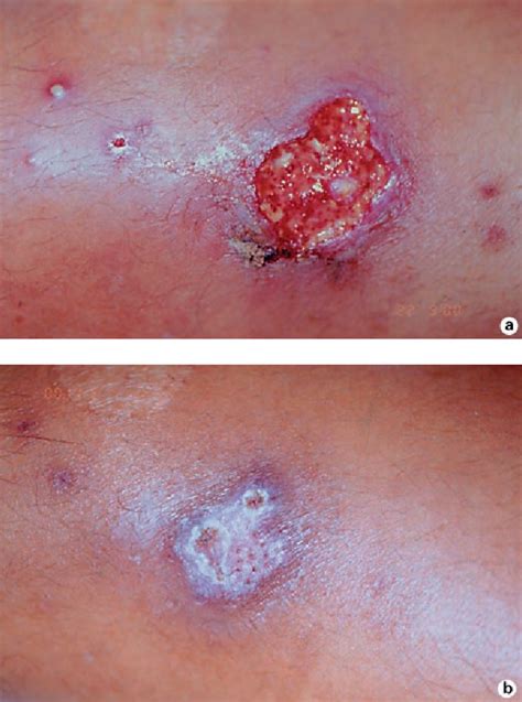 Image result for Pyoderma Gangrenosum Treatment Algorithm