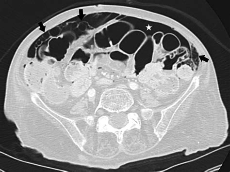 Pneumatosis Cystoides Intestinalis | Applied Radiology