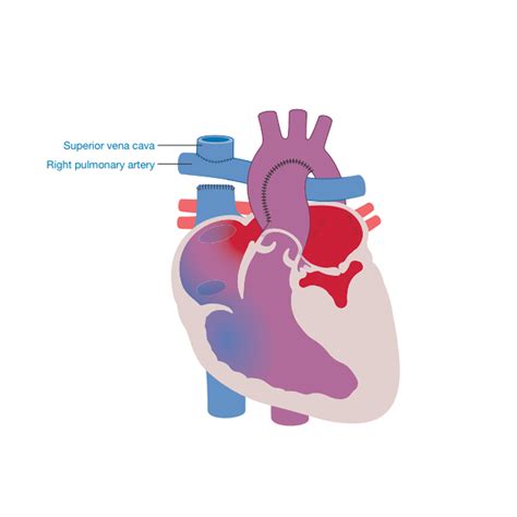 Double Inlet Left Ventricle (DILV) | Little Hearts Matter