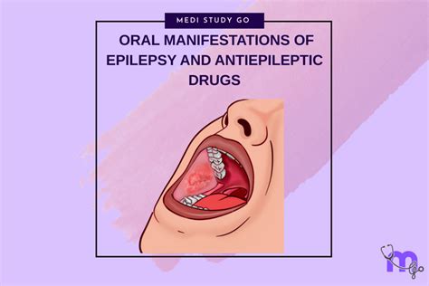 Oral Manifestations of Epilepsy and Antiepileptic Drugs – Medi Study Go