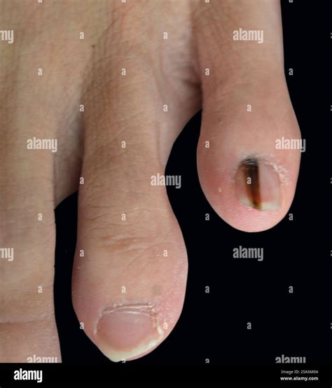 Malignant melanoma on the toenail of a 17 year old female patient. Melanoma is a type of skin ...