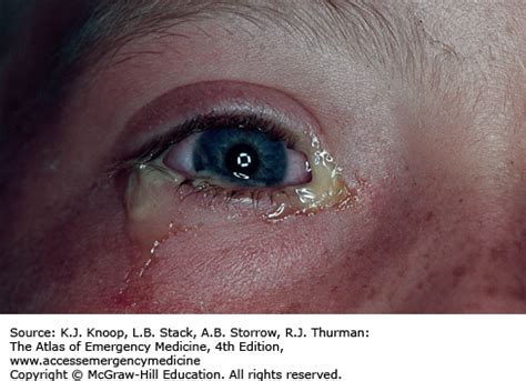 OPHTHALMIC CONDITIONS | Anesthesia Key