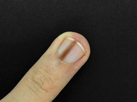Dark Streaks Under Toenail