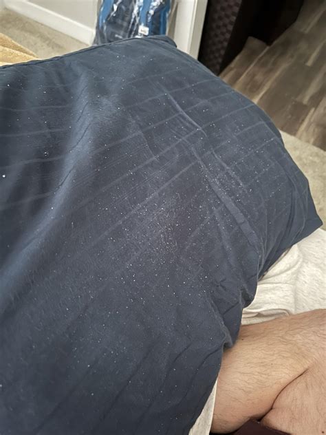 Scalp Dandruff 的图像结果