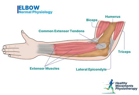 Dry Needling and Tennis Elbow: Does It Really Work - Healthy Movements ...