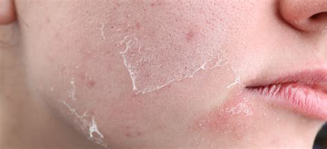 Best Teen Moisturizer for Sensitive Skin | YPlayZ