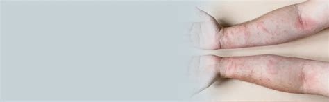 Psoriasis Treatment in Greater Kailash, Delhi | Dermo Rita