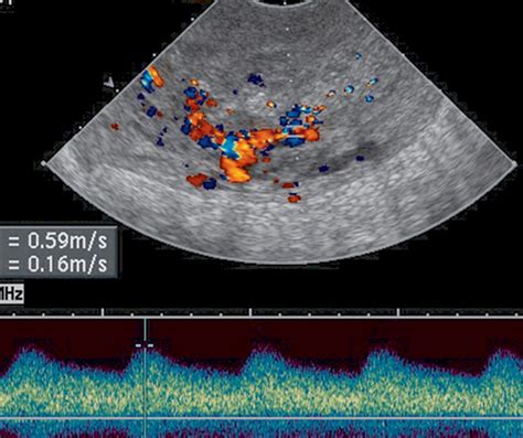 Physiologic, Histologic, and Imaging Features of Retained Products of ...