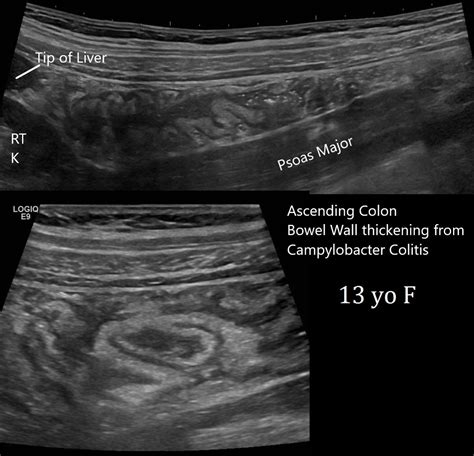 Thickening Of Ascending Colon Colon Wall Thickening: Appearance,