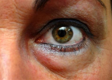 Blefaroplàstia – Institut Cimax