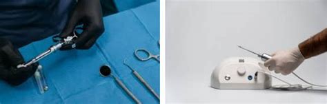 Minimizing Discomfort During Tooth Extraction