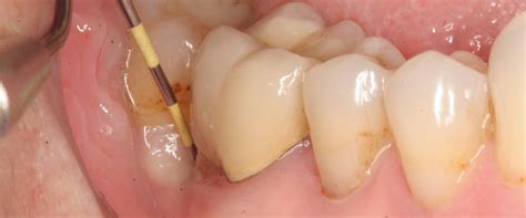 Extracting Abscessed Tooth 的图像结果