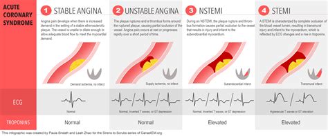 Unstable Angina Vs Stable