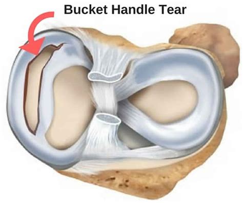 Meniscus tear knee symptoms, signs, diagnosis, treatment and recovery