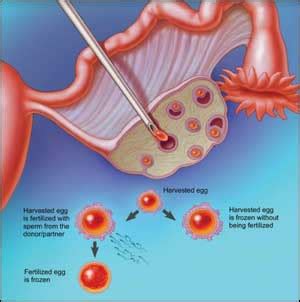 Pune Hospital successfully performs IVF with Cryopreserved Semen