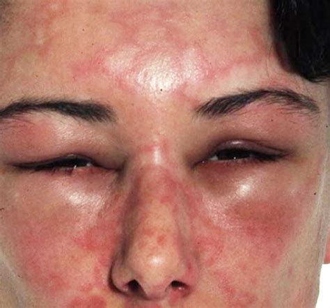Angioedema causes, symptoms, diagnosis and angioedema treatment - symptoms of oedema