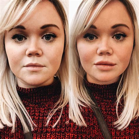 Lip Fillers: Before, During, And After Your Lip Augmentation