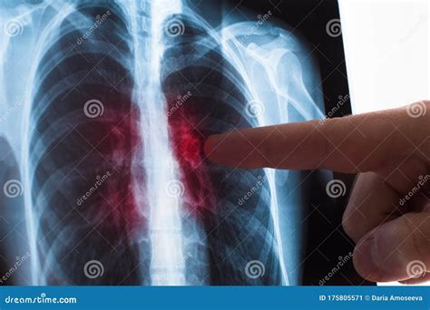 Lung Radiography Concept. Radiology Doctor Examining at Chest X Ray Film of Patient Lung Cancer ...