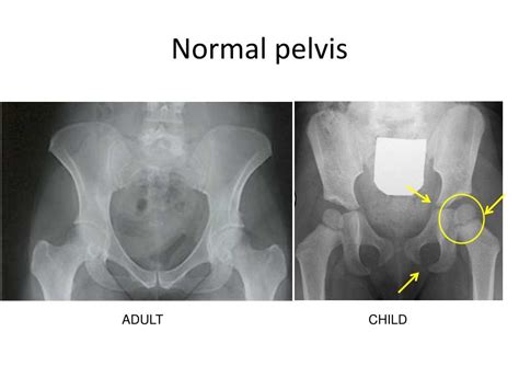 Image result for Pelvic Spring Test