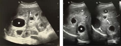 Multiple hepatic cysts in an adult male - Journal of Hepatology