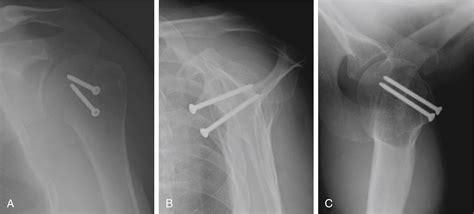 Technique Spotlight: Open Reduction and Bone Grafting of Reverse Hill ...