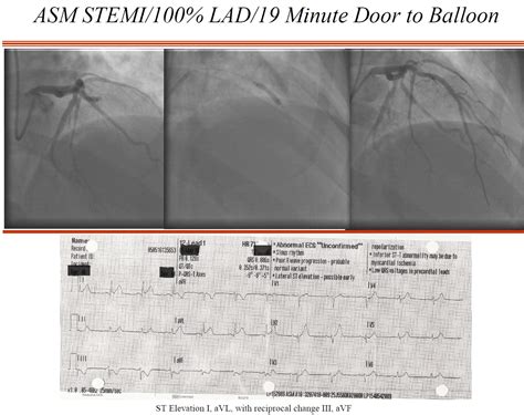Image result for STEMI Cath Lab