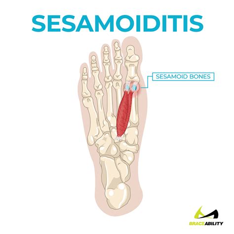 Sesamoid Bone Big Toe Ball Of Foot Pain at Mary Loper blog