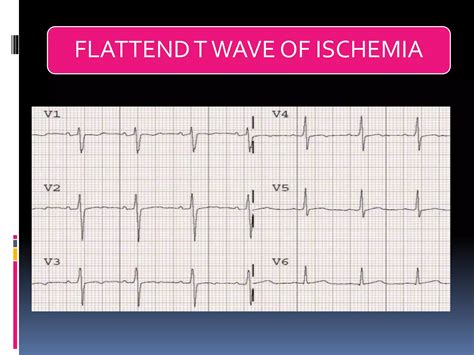 Basic ECG Rhythms 的图像结果