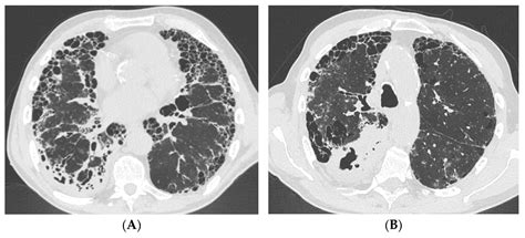 Usual Interstitial Pneumonia Pattern and Mycobacteria Lung Diseases: A ...