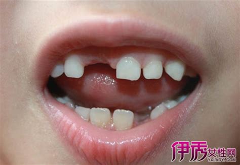 【梦见自己的牙齿掉了好多颗】【图】梦见自己的牙齿掉了好多颗是什么意思 预示你会遇到困难(2)_伊秀星座|yxlady.com