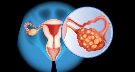 Ovarian Cancer And Hair Growth at Joel Kates blog