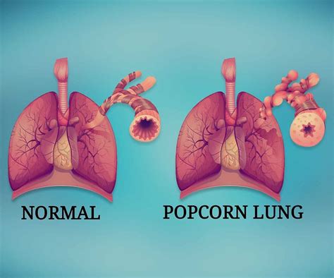 Emphysema Life Expectancy 的图像结果