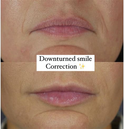 Downturned Mouth Treatment with Botox