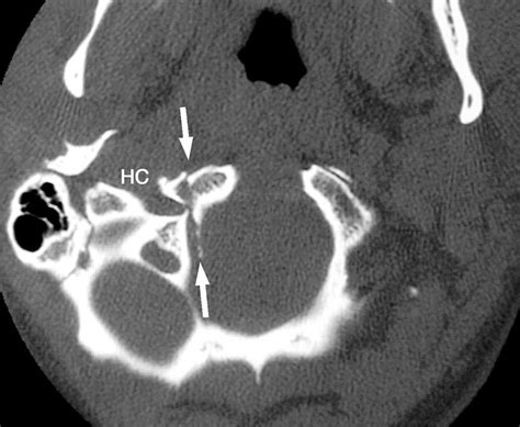Radiologic and Clinical Spectrum of Occipital Condyle Fractures ...