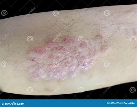 Dermatophytosis, Also Known As Tinea And Ringworm, A Fungal Infection Of The Skin Stock Photo ...